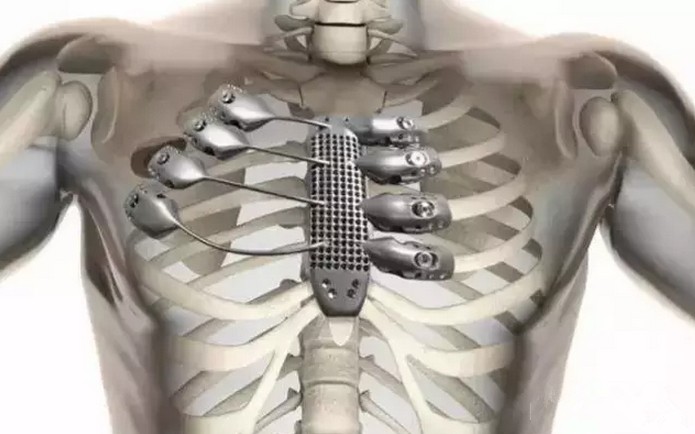 可为患者量身定做的3D打印金属骨骼 - OFwee