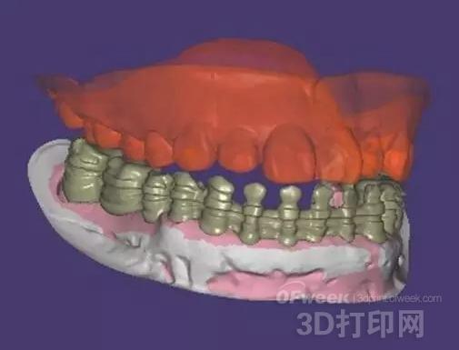 3D扫描软件DentalScan剖析齿科修复数字化流