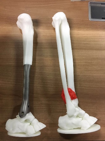 珠江医院林荔军教授团队完成国内首例3D打印胫骨远端假体术