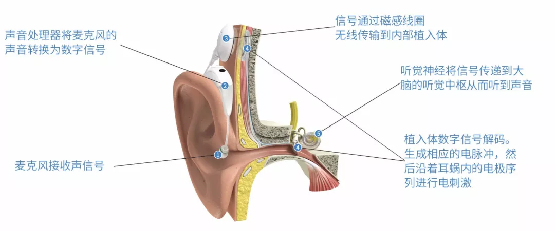用于人工耳蜗的可植入神经接口，LPKF激光技术应用助力医疗植入的发展