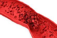 3D打印微流体模型助力研究血栓成因